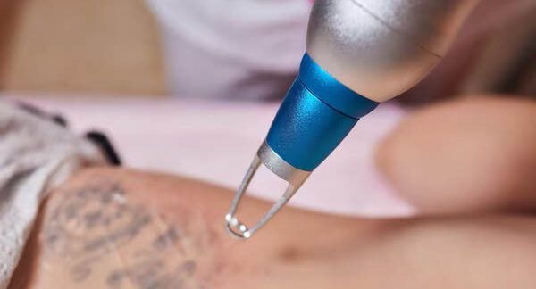 I-10-migliori-centri-di-rimozione-tatuaggi-in-Milano