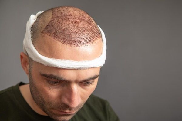 trapianto capelli Milano